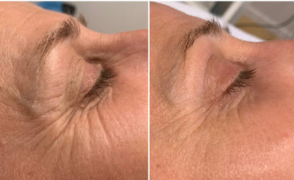 Microneedling With PermaFiltr