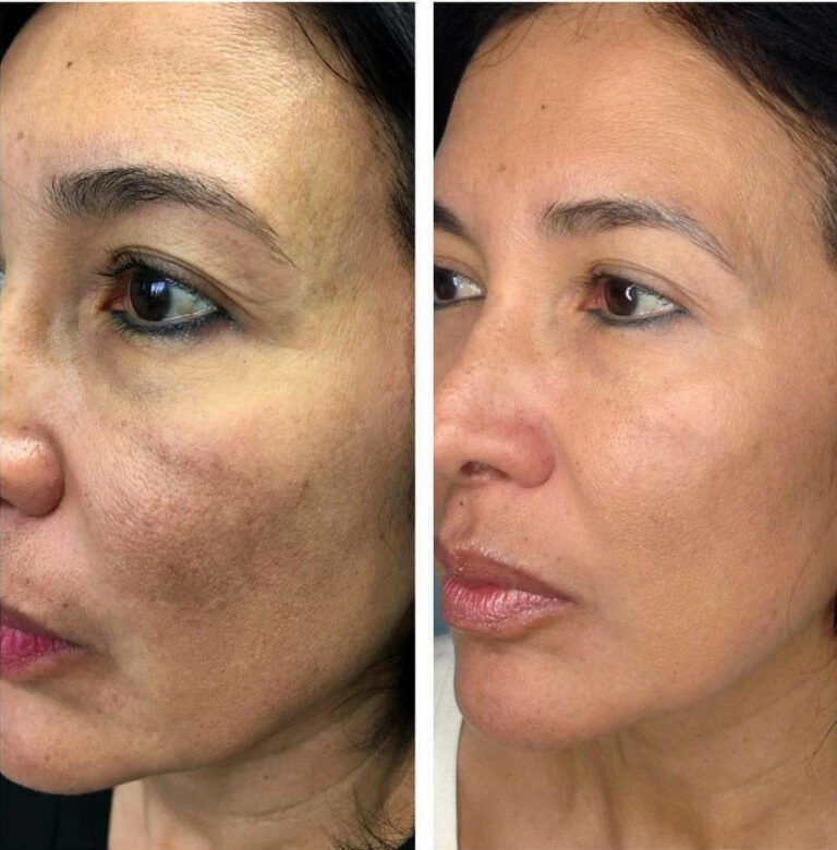 Microneedling With PRP: Package of Three