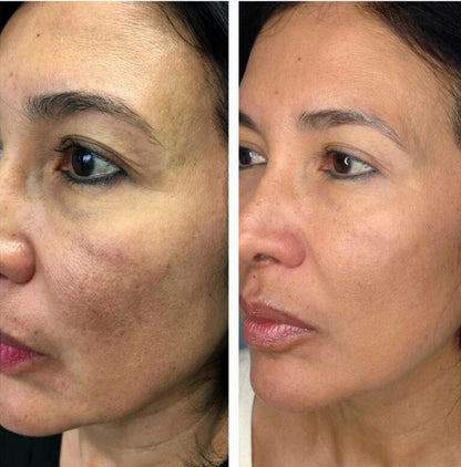Microneedling With PRP: Package of Three