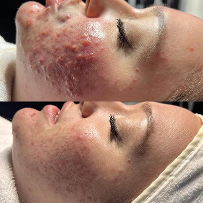 Chemical Peels 20% OFF!