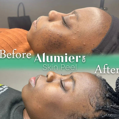 Chemical Peels 20% OFF!