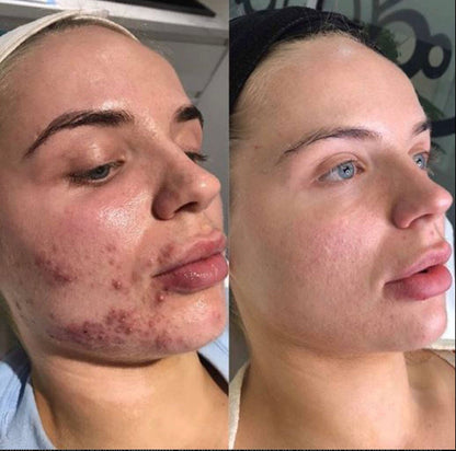 Chemical Peels 20% OFF!