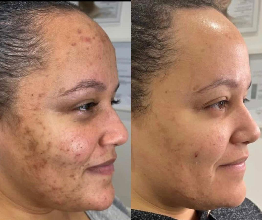 Chemical Peels 20% OFF!