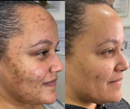 Chemical Peels 20% OFF!