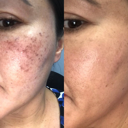 Microneedling With PRP: Package of Three