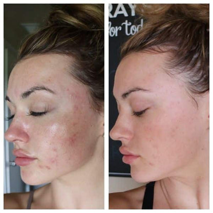 Microneedling With PRP: Package of Three
