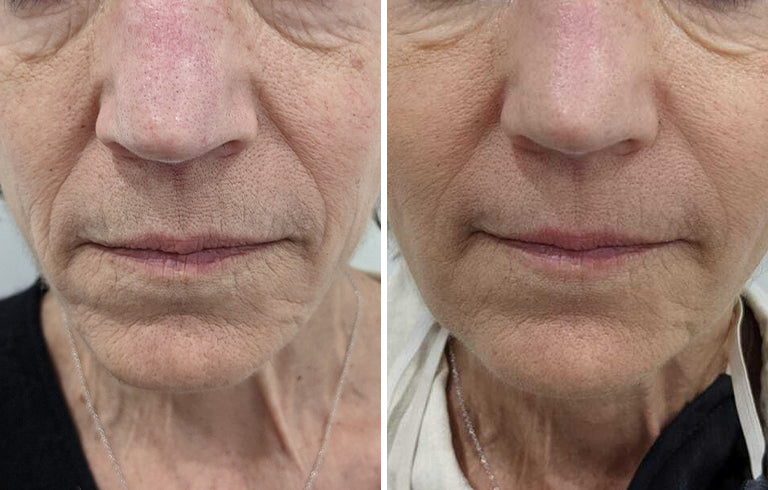 PermaLift (Sculptra)