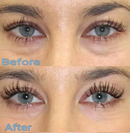 PRP + Filler Undereye Package