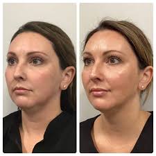 PRP + Filler Undereye Package