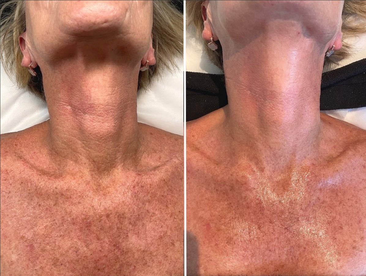 Fire & Ice: Facial Peel Hybrid 25%+ OFF