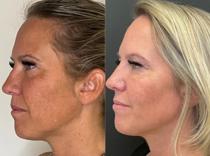 Fire & Ice: Facial Peel Hybrid 25%+ OFF