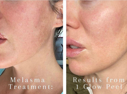 Chemical Peels 20% OFF!