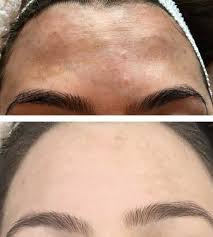 Chemical Peels 20% OFF!