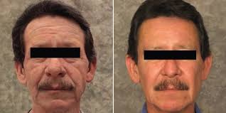 PRP Facelift
