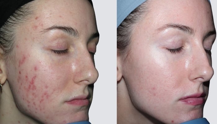 Microneedling