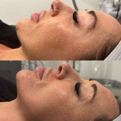 Microneedling