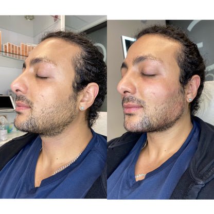 6ML Masculinization Package