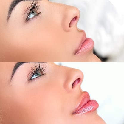 Lip Filler 1/2 Syringe