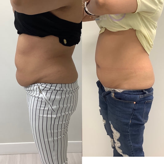 Trusculpt - 45% OFF