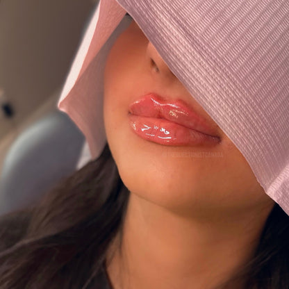 Lip Filler 1/2 Syringe