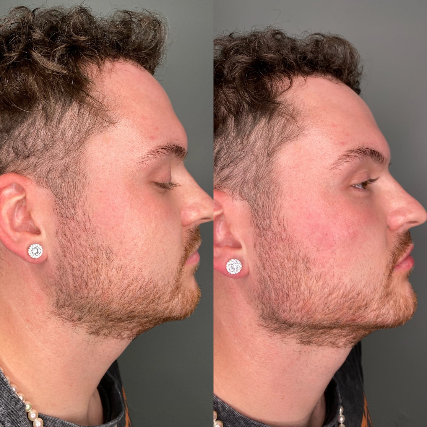 6ML Masculinization Package