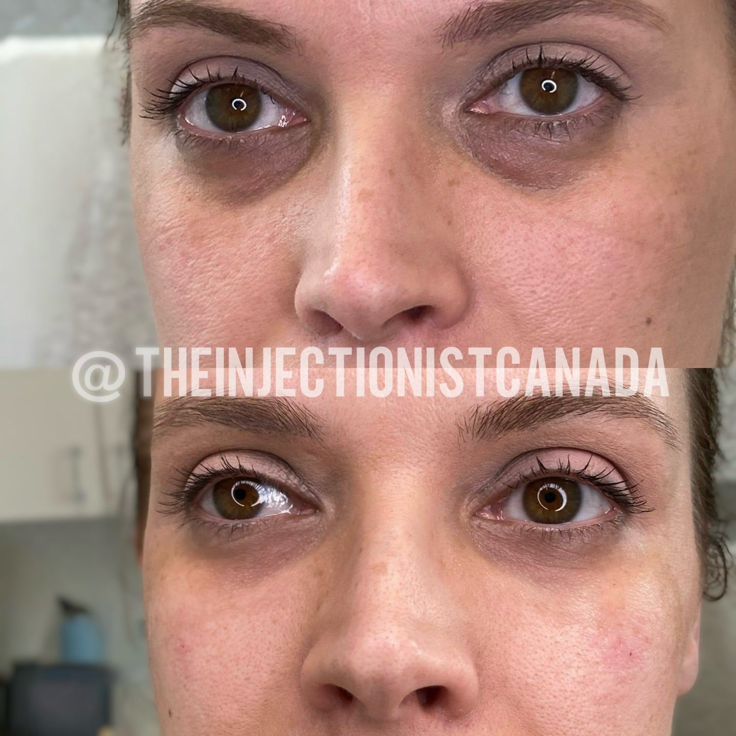 Soft Filler 1 Syringe