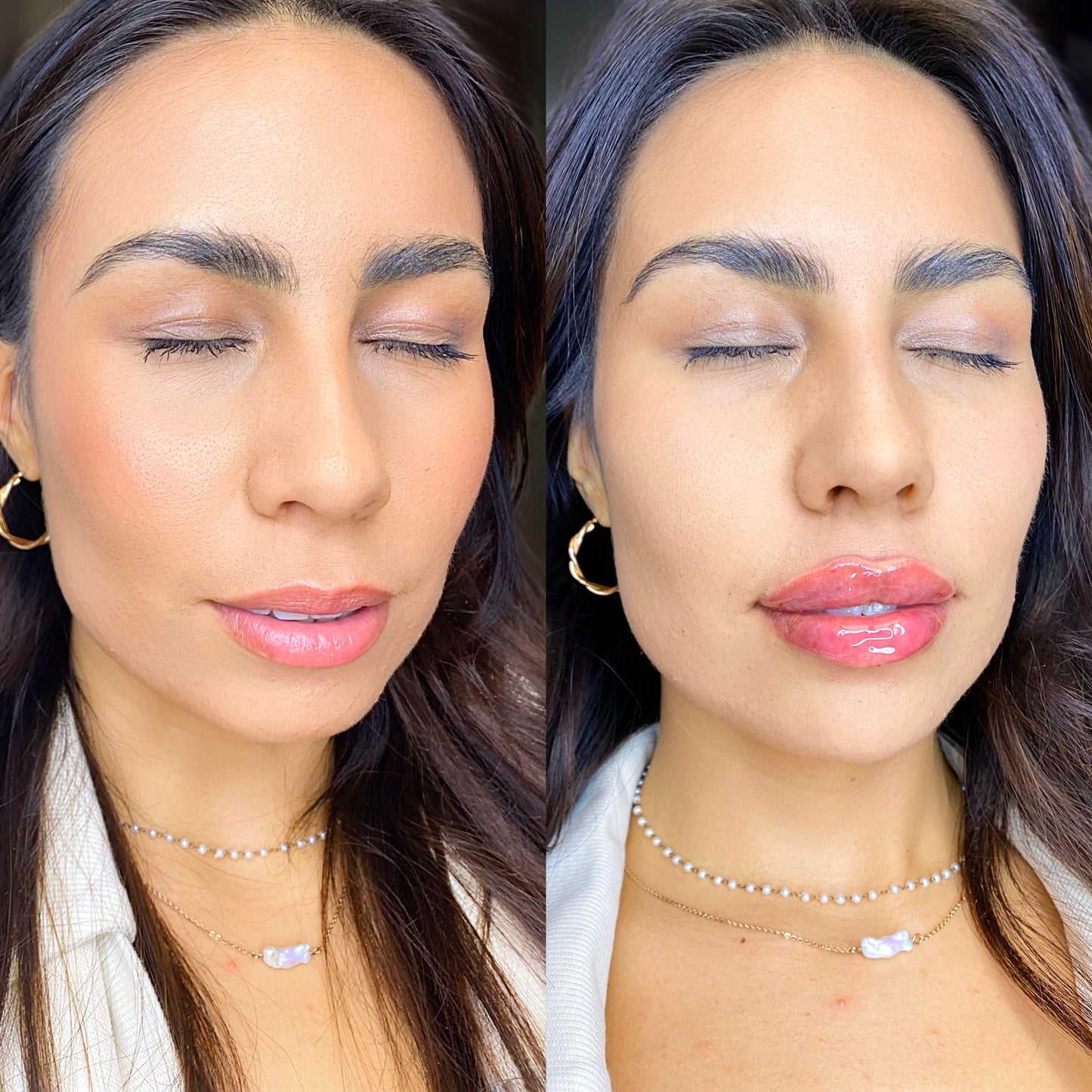 10ML Facelift Package