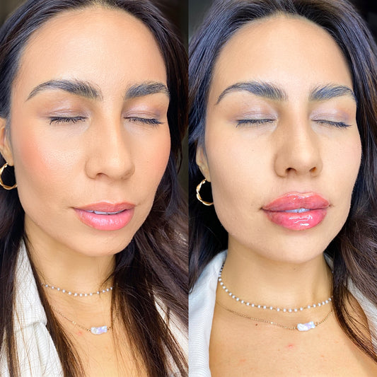 10ML Facelift Package