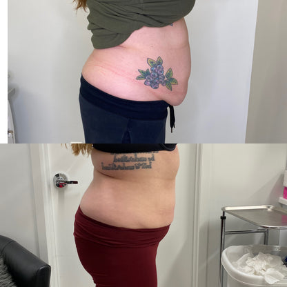 Trusculpt - 45% OFF