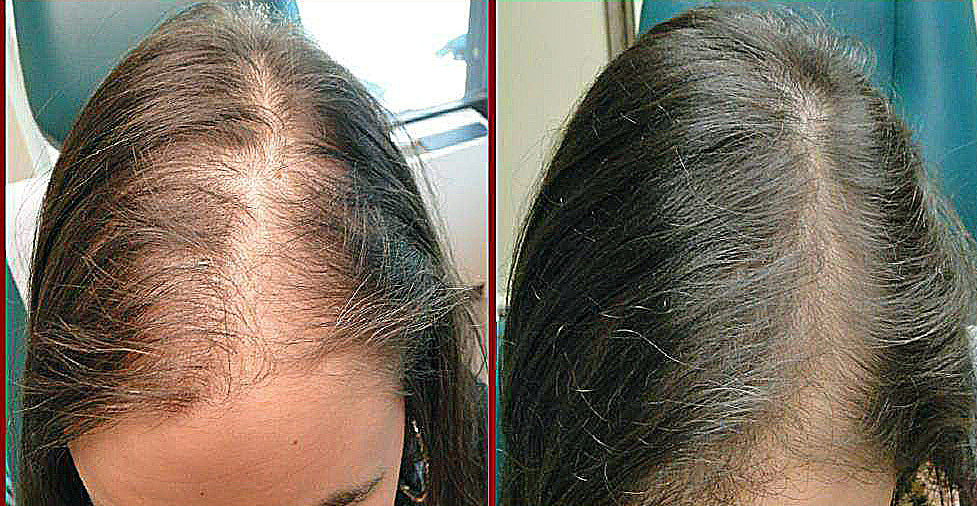 PRP Hair Restoration