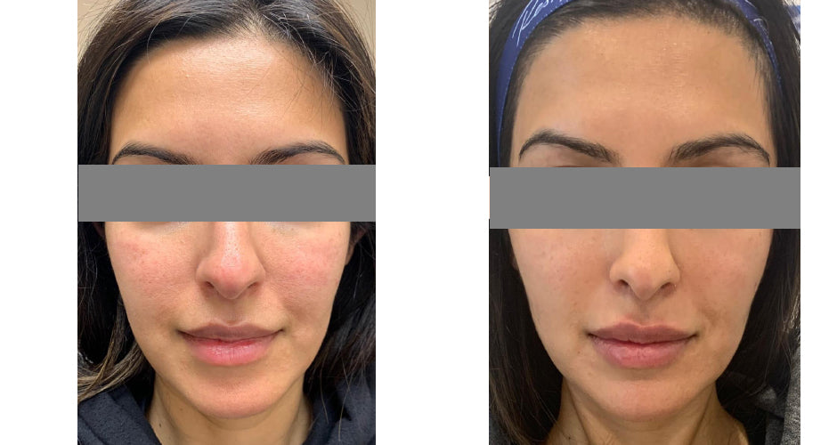 PRP Facelift