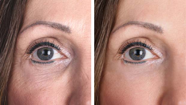 Under Eye PRP