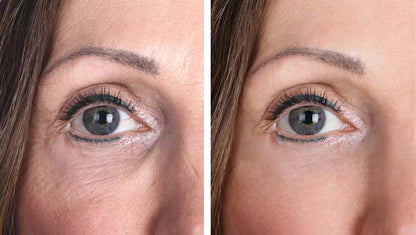 Under Eye PRP