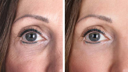 Under Eye PRP