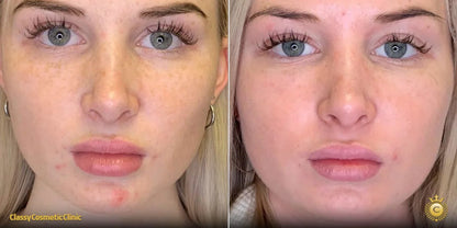 Microneedling With PRP: Package of Three