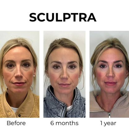 PermaLift (Sculptra)
