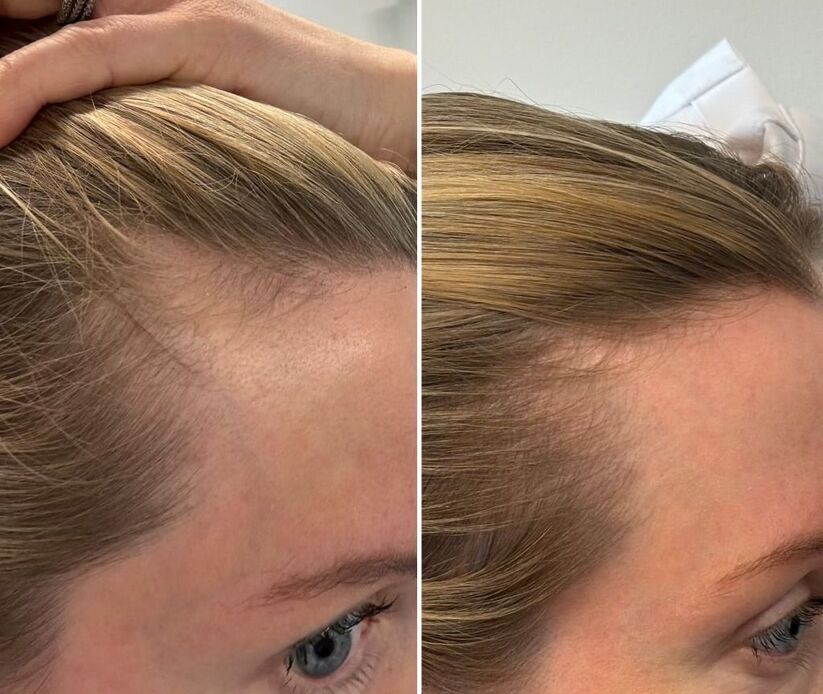 PRP Hair Restoration