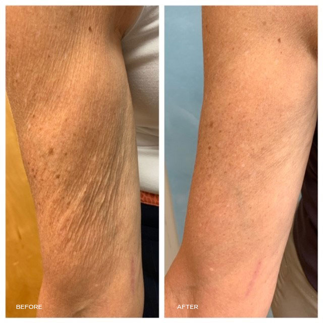 Tempsure Flexsure: Body Tightening + Sculpting