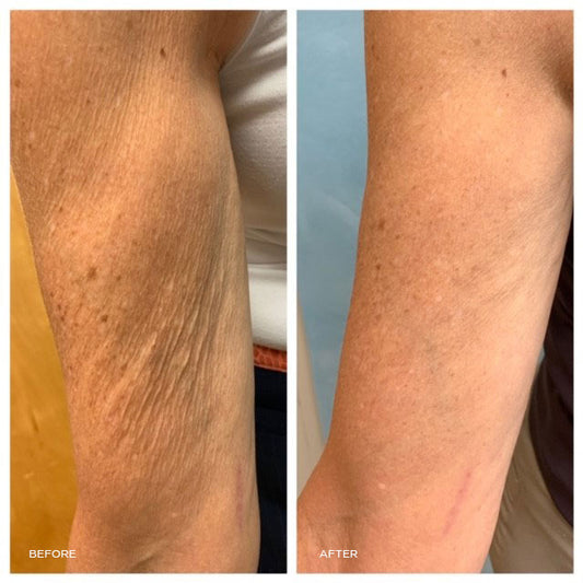 Tempsure Flexsure: Body Tightening + Sculpting