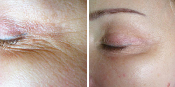Tempsure Envi Eyes Tightening