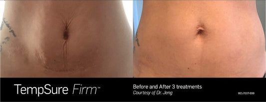Tempsure Firm: Body Tightening